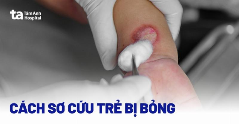 Bị Bỏng Nên Bôi Gì? Lời Khuyên Từ Chuyên Gia Để Xử Lý Vết Bỏng Đúng Cách