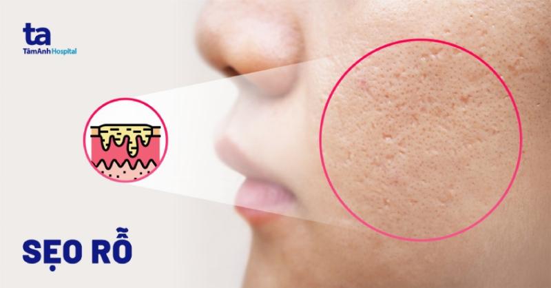 Hình ảnh minh họa sẹo rỗ trên da mặt sau khi khỏi bệnh thủy đậu