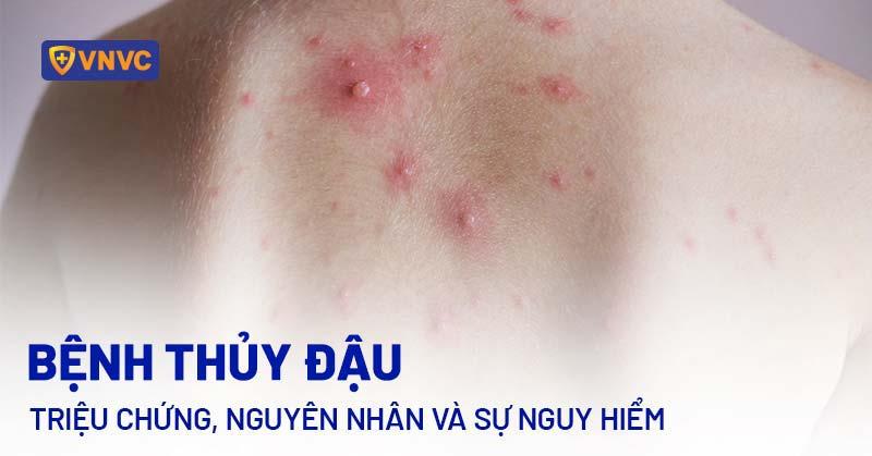 Sốt Xuất Huyết Có Gội Đầu Được Không? Lời Khuyên Từ Chuyên Gia Bệnh Lý