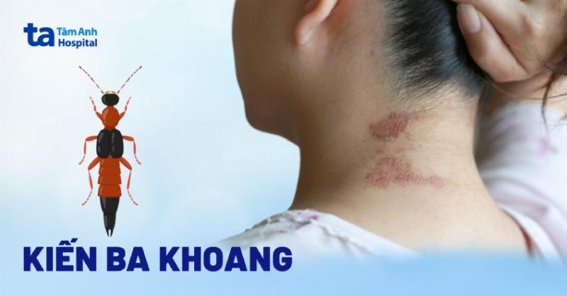 Vẽ hình ảnh minh họa các hành động cần tránh khi xử lý vết kiến cắn
