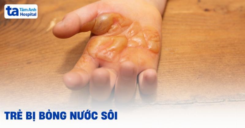 Trẻ Bị Nóng Đầu Chân Tay Bình Thường: Khi Nào Là Tự Nhiên, Khi Nào Cần Lưu Ý?