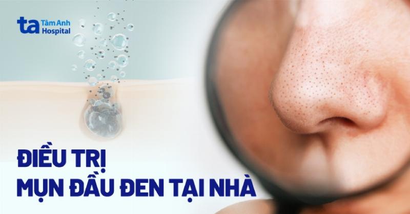 Cách Làm Hết Mụn Đầu Đen Ở Mũi: Từ Chuyên Gia Da Liễu Đến Chăm Sóc Tại Nhà