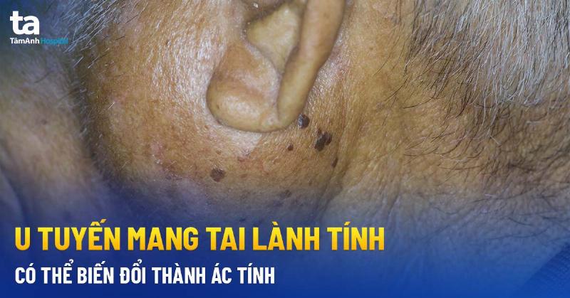 Các triệu chứng phổ biến của u tuyến nước bọt mang tai